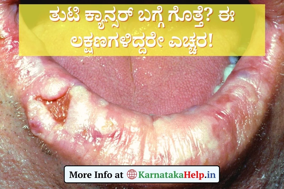Lip Cancer: ನಿಮಗೆ ತುಟಿ ಕ್ಯಾನ್ಸರ್ ಬಗ್ಗೆ ಗೊತ್ತೆ? ಈ ಲಕ್ಷಣಗಳಿಂದ ಎಚ್ಚರ!